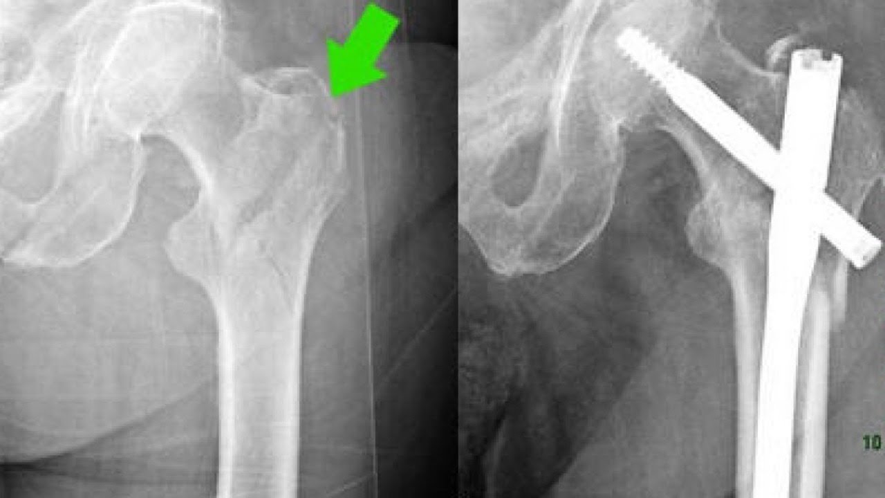 Срастись без операции могут. Перелом шейки бедра остеосинтез. Подвертельный перелом бедра рентген. Чрезвертельный перелом бедренной кости со смещением рентген. Перелом шейки бедра остеосинтез рентген.