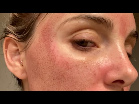 7 DAY AGGRESSIVE HALO LASER HEALING PROCESS - YouTube