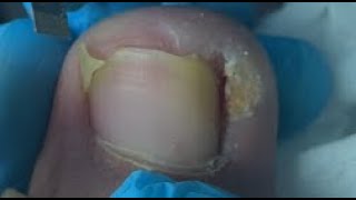 Satisfying ingrown toenail repair