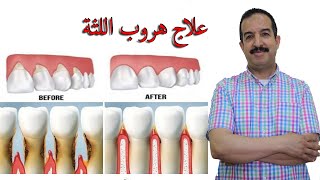 علاج هروب اللثة عن الأسنان