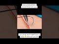    الخياطة الجراحية