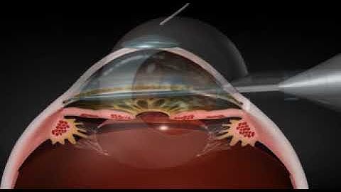 Kahook Dual Blade Goniotomy