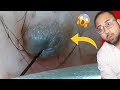 Deep Ingrown Hair Extractions – Crazy Huge!