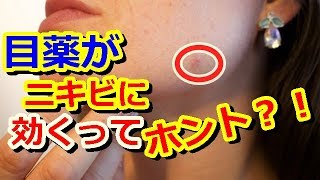 【裏ワザ】目薬がニキビに効く裏技とは?試さずにはいられない!