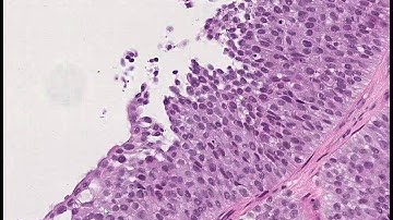 TURBT (trans-urethral resection bladder tumour)