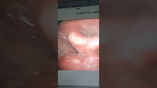 Candidial ulcer throat / Fungal ulcer throat / ગળામાં ફૂગના ચાંદા જુઓ - Dr Hitesh Patel