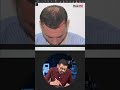 How We Transformed a 27-Year-Old’s Hairline and Crown! | Case Study | HairMD, Pune