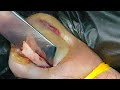 Shocking video of the most extreme ingrown toenail of 2024