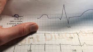 Wie verwendet man ein EKG Lineal?