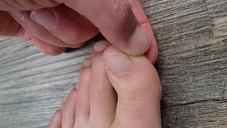 Ingrown toenail relief