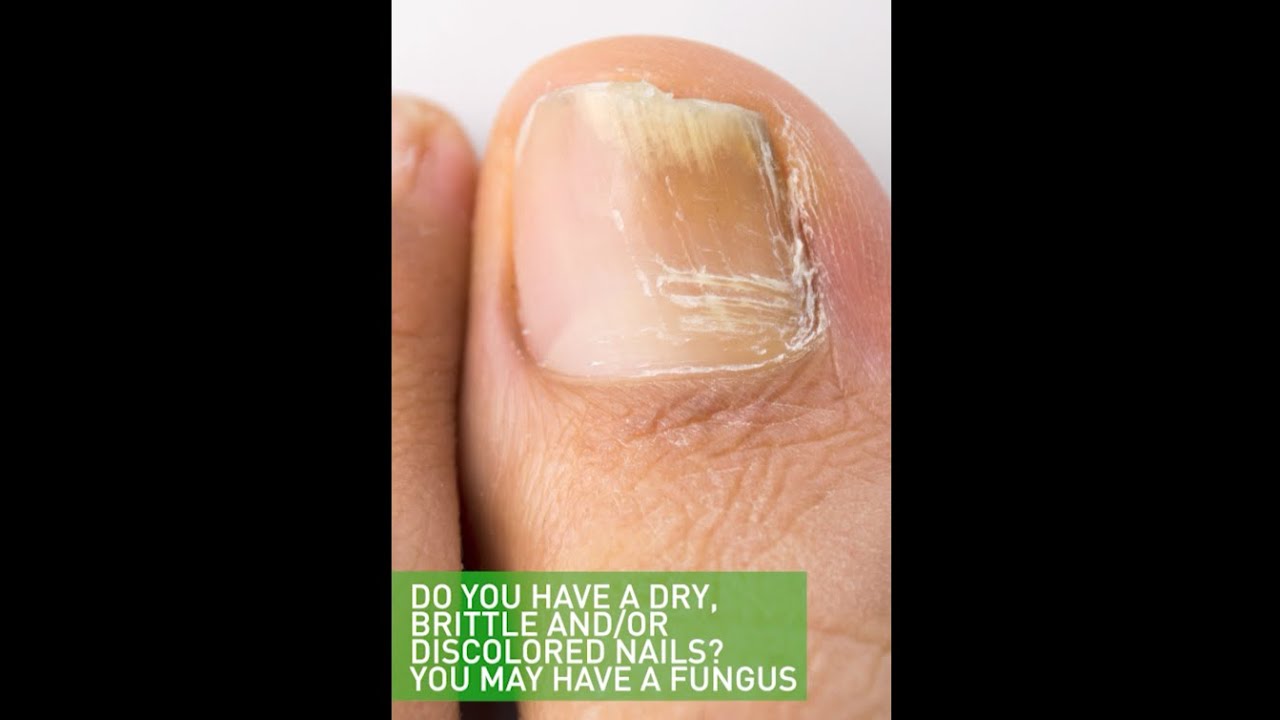 5 Things To Know About Toenail Fungus And COVID-19