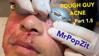TOUGH GUY ACNE PART 1.5! So much inflammation! Acne extractions. So many pores cleared.