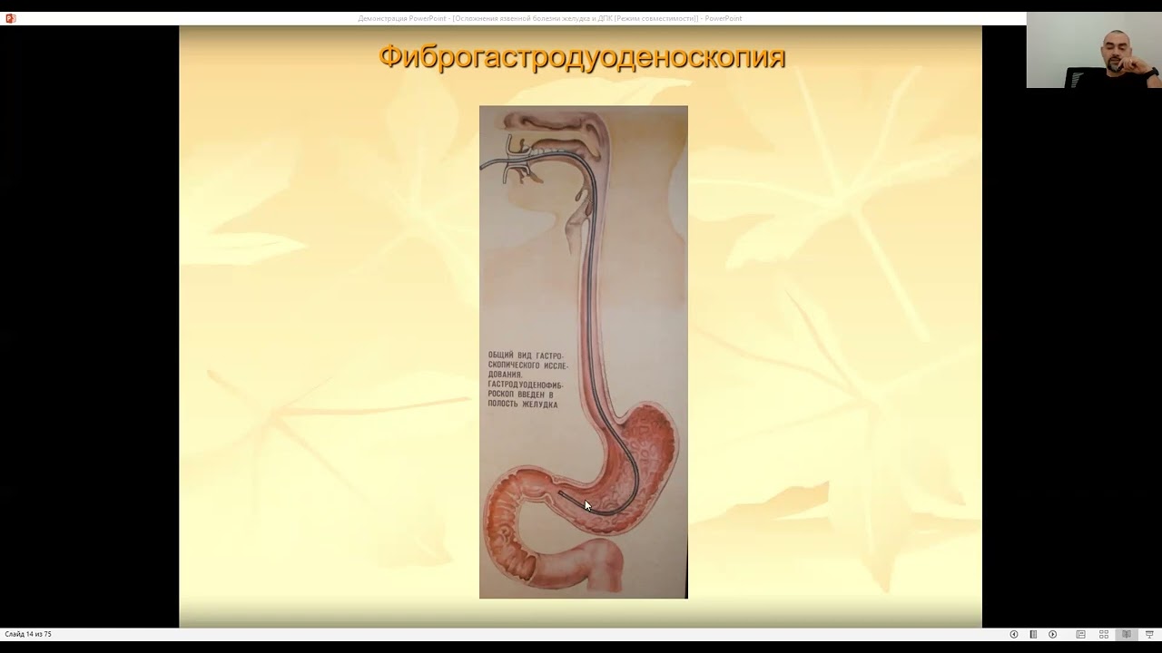 Осложнения язвенной болезни желудка и ДПК