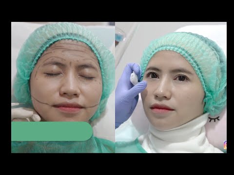 Video: Botox Untuk Garis Senyum: Prosedur, Biaya, Gambar, Dan Lainnya