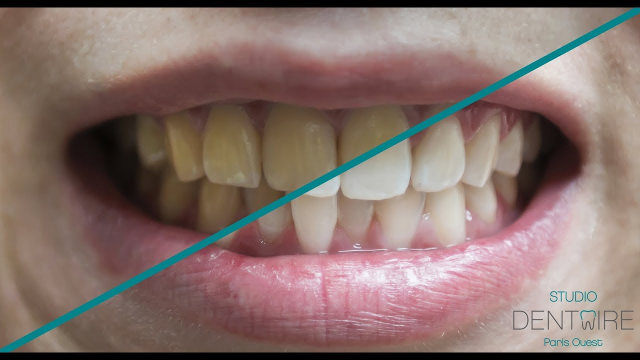 Le blanchiment dentaire