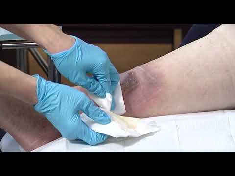 Video: Wie kan debridement doen?