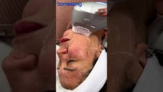 7D HIFU Wrinkle Removal Treatment