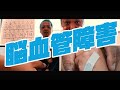 脳血管障害と経絡治療｜鍼灸臨床Vlog