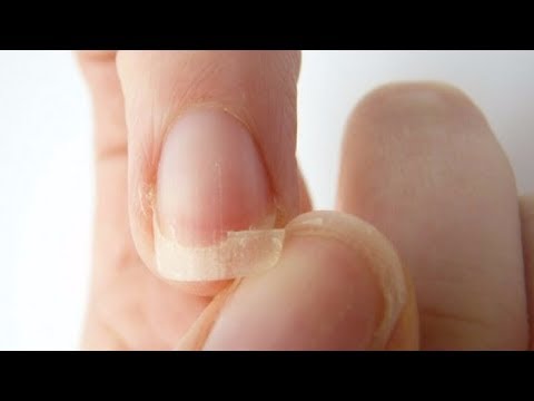 If You Have Thin Brittle Nails Insomnia Or Hair Loss Start Eating