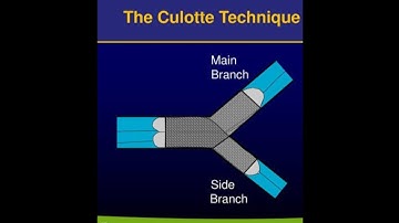 LAD - Diagonal bifurcation stenting with culotte technique  #angioplasty #cathlab