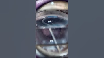 Minimally Invasive Glaucoma Surgery with the OMNI Edge Surgical System