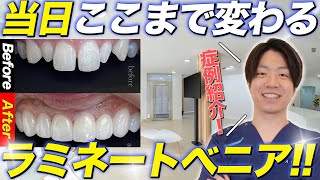 ガタガタの歯が綺麗に並び白く!ラミネートべニアの症例を解説!