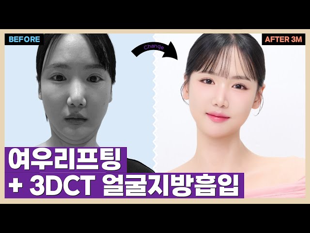 윤곽수술 후 살처짐...에이탑성형외과에서 해결했다! I 3D-CT얼굴지방흡입+실리프팅+여우리프팅 리얼후기 😲