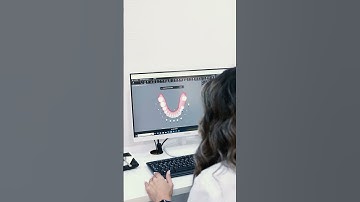 #invisalign Treatment Planning in TIMELAPSE!