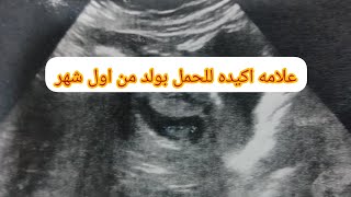# شكل كيس الحمل بالجنين الذكر من أول شهر