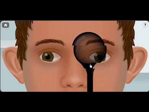 Exodeviation Intermittent Exotropia By Dr Khalil Al Salem Youtube