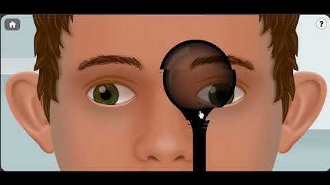 exodeviation, intermittent exotropia by Dr. Khalil Al-Salem
