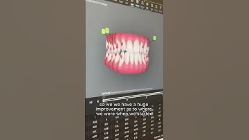 Complex Invisalign Case Success: 18 Months, Rubber Bands & Full Bite Correction