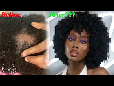 I WAS GOING BALD via SCALP FUNGUS (4C/B/A NATURAL HAIR) + GROW back MY JOURNEY #ScalpCare | EfikZara