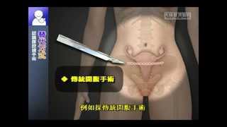 【知情同意】認識腹腔鏡手術(台語)