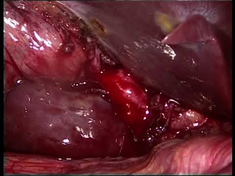 15062015 Laparoscopic cholecystectomy with intraoperative cholangiogram (LC + IOC) part 1