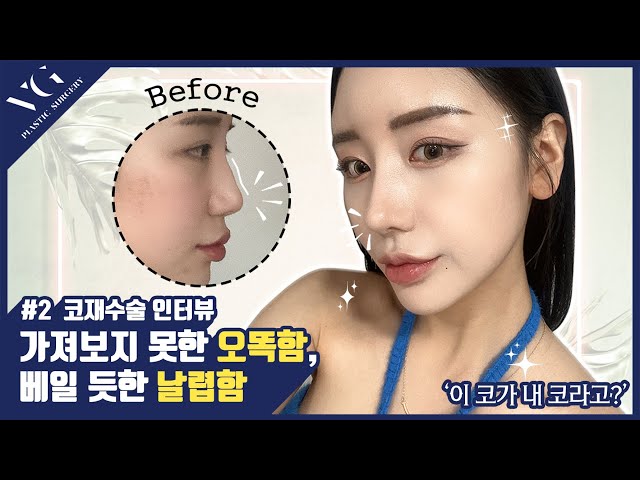 #코재수술  #성형 #브이로그 두번은 없는 코재수술인터뷰😎가져보지 못한 오똑함, 베일 듯한 날렵함!