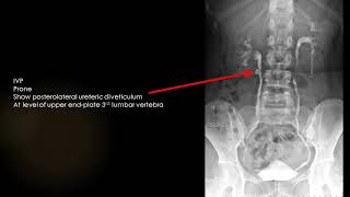 CASE 842  IVP ureteric diveticulum,stricture