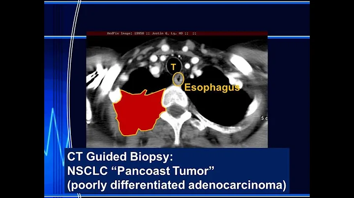 Pancoast Tumor and Superior Sulcus Lung Mass