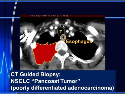 Pancoast Tumor and Superior Sulcus Lung Mass