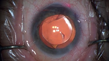 iTrack™ Procedural Steps: Viscodilation
