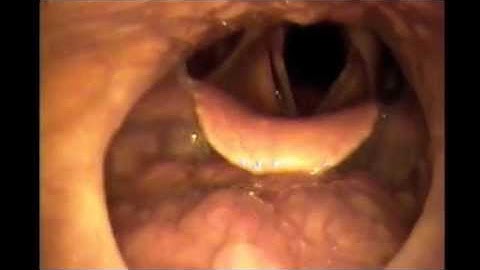 Where Snoring Comes From (Sleep Endoscopy)