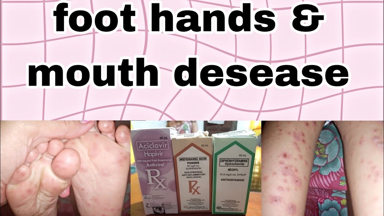 Anong gamot sa Foot hand & Mouth deceased Jervian'zVlogs YouTube