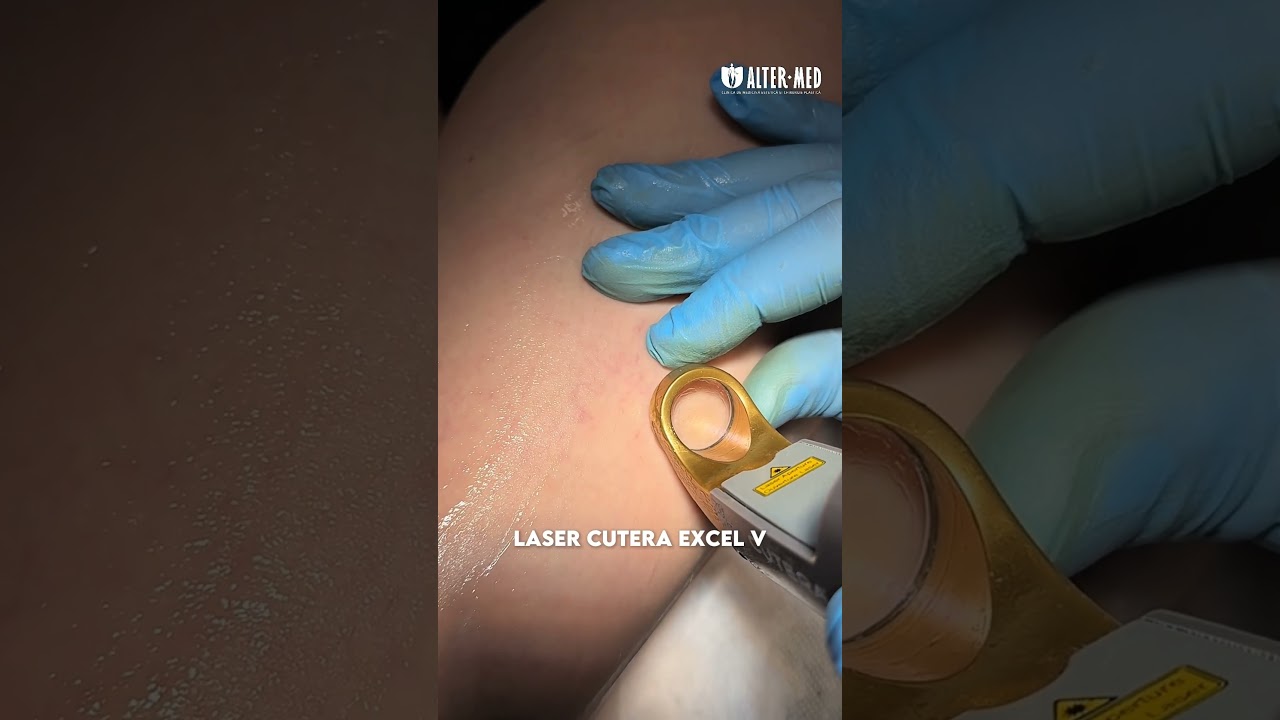 Laser Cutera Excel V - 📍Alter-MED