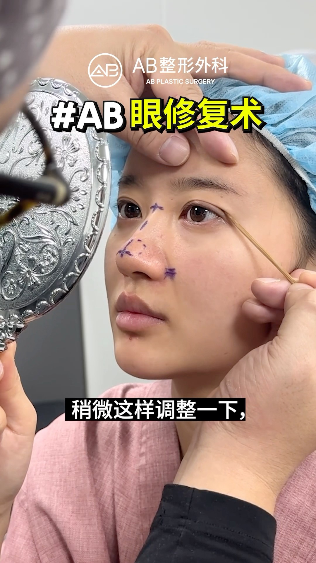 雙眼皮修修1個月！根本像天生的 #shorts