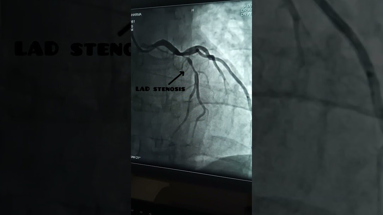 "Blocked Heart Alert! 🚨 LAD stenosis is no joke"