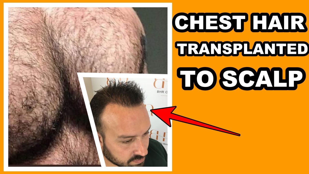FUE SURGERY BODY HAIR TO SCALP | What Happened With His Chest Hair? #shorts  #hairtransplantresults - YouTube