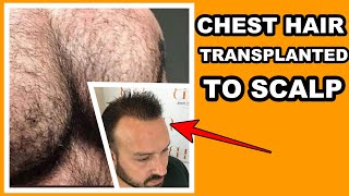 FUE SURGERY BODY HAIR TO SCALP | What Happened With His Chest Hair? #shorts #hairtransplantresults Chest Hair Transplant Before And After