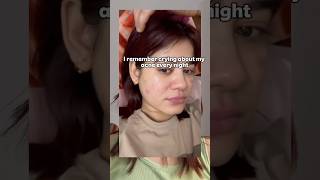 Acne prone girlies check this out💗 #ytshorts #youtube #skincare #fyp #viral #acne #clearskin #skinq