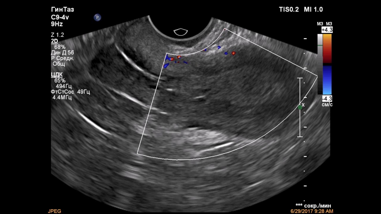 Лечение гиперплазии в постменопаузе. Гиперплазия эндометрия в менопаузе УЗИ. Гиперплазия эндометрия по УЗИ В менопаузе. Разрастание слизистой матки в менопаузе.