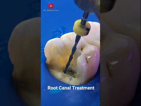 Tratamiento de Conductos | Restauración Dental #satisfying #dentist